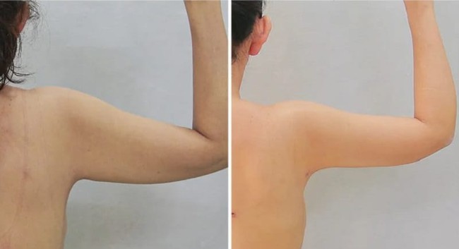 MXH rúng động vụ cánh tay biến dạng sau hút mỡ, cắt da thừa giá 10 triệu đồng: BS nói đi làm đẹp cần ghi nhớ điều này tránh tiền mất tật mang - Ảnh 3. MXH rúng động vụ cánh tay biến dạng sau hút mỡ, cắt da thừa giá 10 triệu đồng: BS nói đi làm đẹp cần ghi nhớ điều này tránh tiền mất tật mang - Ảnh 3.