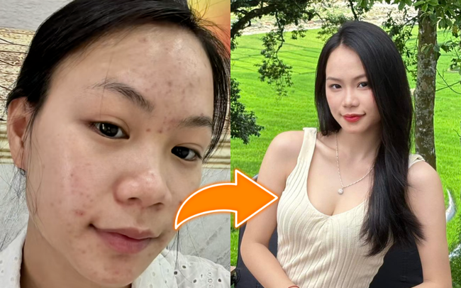 Trị mụn ẩn, thâm mụn trong 1 tuần, cô nàng dùng chiêu đơn giản đến không ngờ - Ảnh 1. Trị mụn ẩn, thâm mụn trong 1 tuần, cô nàng dùng chiêu đơn giản đến không ngờ - Ảnh 1.