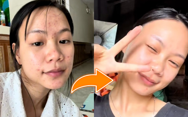 Trị mụn ẩn, thâm mụn trong 1 tuần, cô nàng dùng chiêu đơn giản đến không ngờ - Ảnh 5. Trị mụn ẩn, thâm mụn trong 1 tuần, cô nàng dùng chiêu đơn giản đến không ngờ - Ảnh 5.