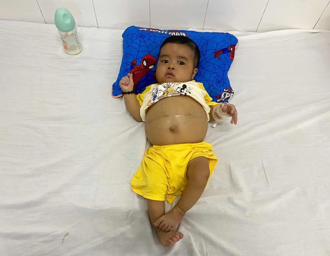 Ánh mắt cầu cứu của bé trai 7 tháng tuổi bụng to bất thường vì bệnh hiểm nghèo - Ảnh 2. Ánh mắt cầu cứu của bé trai 7 tháng tuổi bụng to bất thường vì bệnh hiểm nghèo - Ảnh 2.