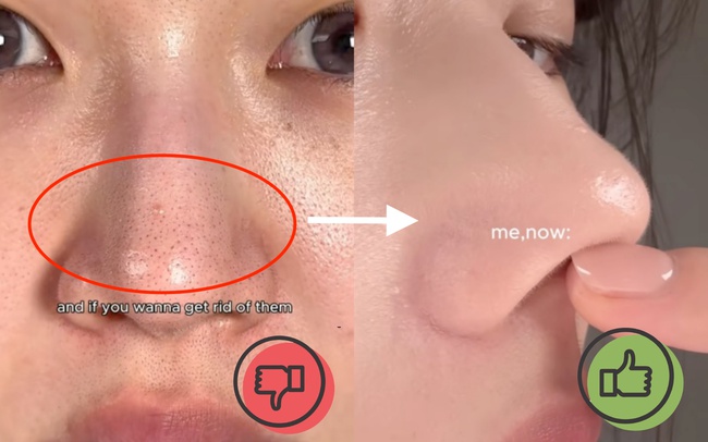Cách rửa mặt trị mụn đầu đen của phái đẹp Hàn hiệu quả đến bất ngờ - Ảnh 8.