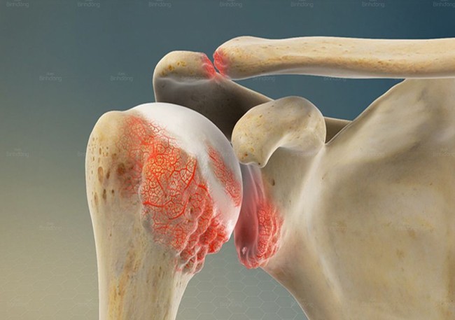 Từng tự hào chốt trăm đơn mỗi ngày, giờ tôi phải gác lại tất cả vì thoái hóa đốt sống cổ... - Ảnh 3.