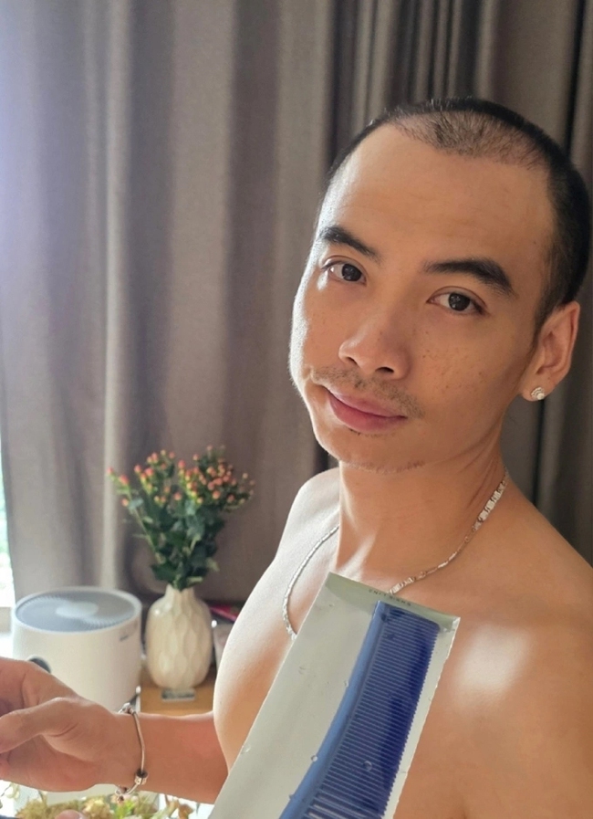 Chồng H'Hen Niê thay đổi thế nào sau cấy tóc trị hói đầu? Phương pháp này có giá bao nhiêu? - Ảnh 1. Chồng H'Hen Niê thay đổi thế nào sau cấy tóc trị hói đầu? Phương pháp này có giá bao nhiêu? - Ảnh 1.