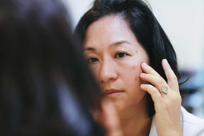 Nám da: Làm thế nào để điều trị hiệu quả theo khuyến cáo của chuyên gia da liễu? - Ảnh 2. Nám da: Làm thế nào để điều trị hiệu quả theo khuyến cáo của chuyên gia da liễu? - Ảnh 2.