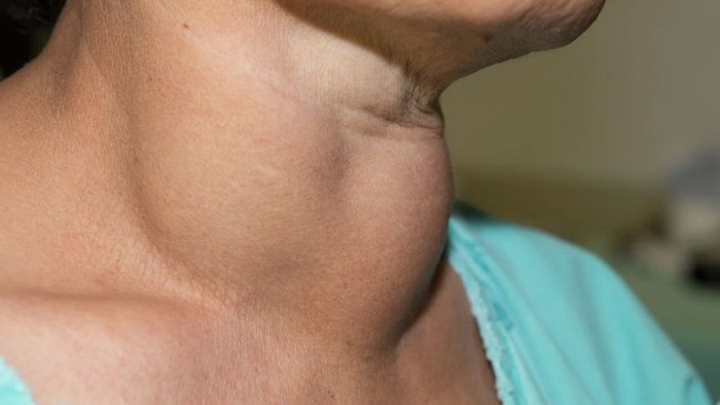 Bị cường gi&aacute;p cứ uống hết thuốc lại bị, nữ bệnh nh&acirc;n đi kh&aacute;m lại ph&aacute;t hiện th&ecirc;m ung thư tuyến gi&aacute;p  - Ảnh 1.