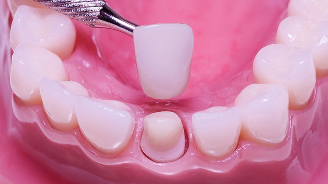 Dàn &quot;em xinh&quot; không dao kéo vẫn đẹp lấp lánh: Hóa ra đều đã thẩm mỹ răng theo cách này bảo sao visual ai nhìn cũng xuýt xoa - Ảnh 4.