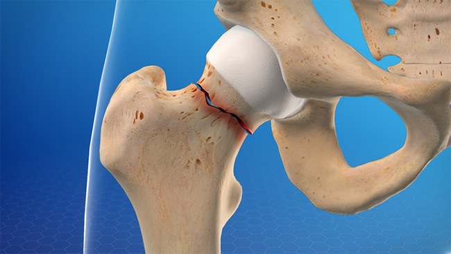 Phụ nữ mãn kinh khó tránh loãng xương: Nếu bạn không thuộc 3 nhóm sau thì xin chúc mừng! - Ảnh 2.