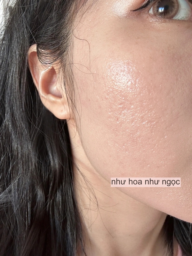 Tôi đã trẻ hóa da thành công nhờ collagen, mất đúng 2 năm để thay đổi làn da sẹo rỗ - Ảnh 2. Tôi đã trẻ hóa da thành công nhờ collagen, mất đúng 2 năm để thay đổi làn da sẹo rỗ - Ảnh 2.