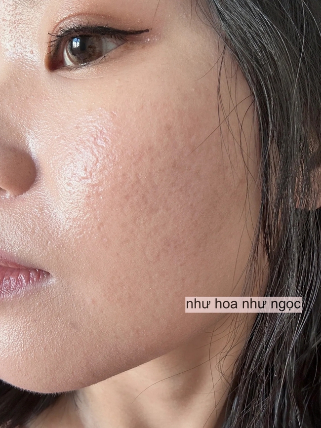 Tôi đã trẻ hóa da thành công nhờ collagen, mất đúng 2 năm để thay đổi làn da sẹo rỗ - Ảnh 1. Tôi đã trẻ hóa da thành công nhờ collagen, mất đúng 2 năm để thay đổi làn da sẹo rỗ - Ảnh 1.