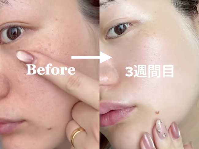 Cách trị nám của phụ nữ Nhật: 1 tuần hết nám da, các nàng thử - Ảnh 2.