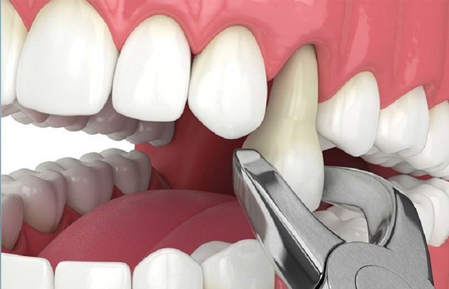 Cụ ông 77 tuổi qua đời sau khi cấy 6 implant và nhổ 12 răng: Có phải càng nhiều tuổi càng không nên nhổ răng, cấy implant? - Ảnh 3.