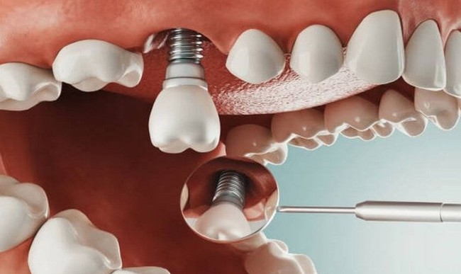 Cụ ông 77 tuổi qua đời sau khi cấy 6 implant và nhổ 12 răng: Có phải càng nhiều tuổi càng không nên nhổ răng, cấy implant? - Ảnh 4.