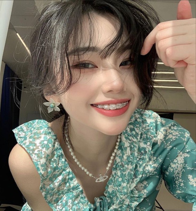 Niềng răng sai cách: Gây lệch mặt, sưng hàm, đau khớp - Ảnh 2. Niềng răng sai cách: Gây lệch mặt, sưng hàm, đau khớp - Ảnh 2.