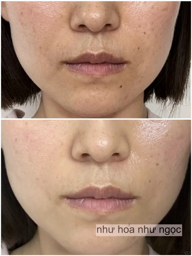 Chụp ảnh mặt mộc hàng ngày trong 1 tháng khi uống collagen, có 1 điểm trên mặt thay đổi mà tôi nhận thấy rõ  - Ảnh 5.