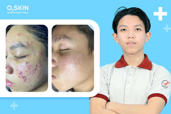 Mụn tuổi dậy th&igrave;: 3 sai lầm của cha mẹ c&oacute; thể để lại sẹo t&acirc;m l&yacute; vĩnh viễn cho con - Ảnh 2.