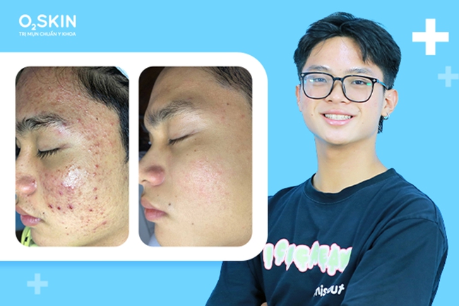 Mụn tuổi dậy th&igrave;: 3 sai lầm của cha mẹ c&oacute; thể để lại sẹo t&acirc;m l&yacute; vĩnh viễn cho con - Ảnh 3.