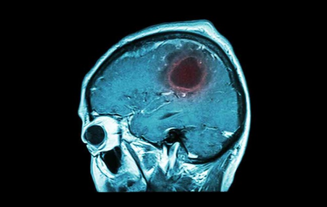 7 dấu hiệu cảnh báo khối u não bạn đừng coi thường - Ảnh 1.