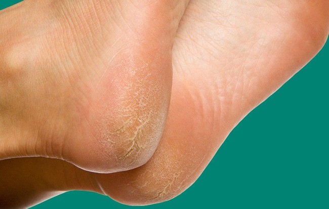 7 lý do khiến chân bạn bong vảy khủng khiếp trong mùa hè - Ảnh 1.