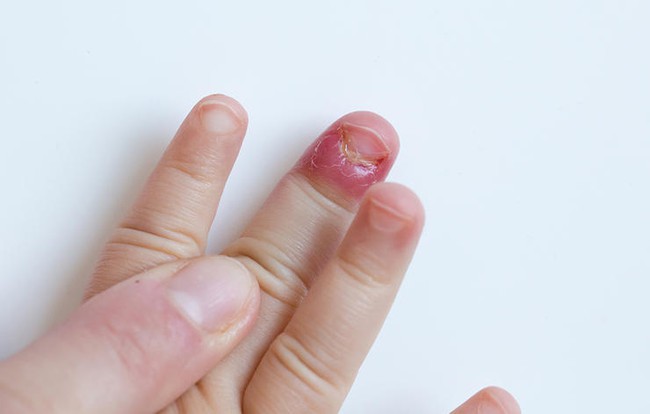 Đừng coi thường thói quen cắn móng tay, chúng có thể là nguyên nhân dẫn đến những chứng bệnh này - Ảnh 4.