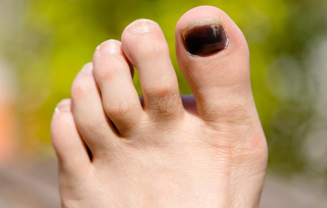 Đen móng chân không chỉ là do tụ máu, nhiều căn bệnh đáng sợ khác được cảnh báo từ dấu hiệu này - Ảnh 1.