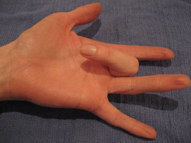 Tình trạng kỳ quặc này có thể khiến ngón tay bạn không hoạt động được - Ảnh 1.
