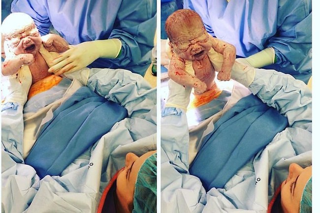 Khoảnh khắc ấn tượng: Bà mẹ sinh mổ tự đưa tay lấy con ra khỏi bụng - Ảnh 1.