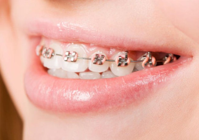 Những nguyên nhân không ngờ khiến bạn bị chảy máu nướu răng - Ảnh 6.