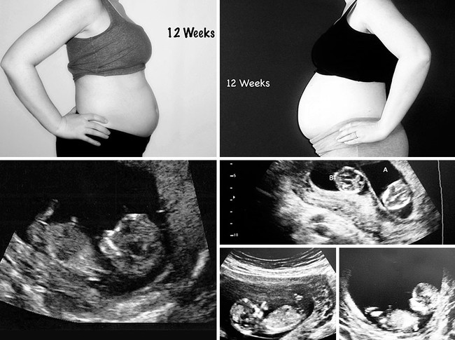 Nếu bạn tò mò mang thai đơn và song thai khác nhau thế nào, hãy xem những hình ảnh này - Ảnh 3.