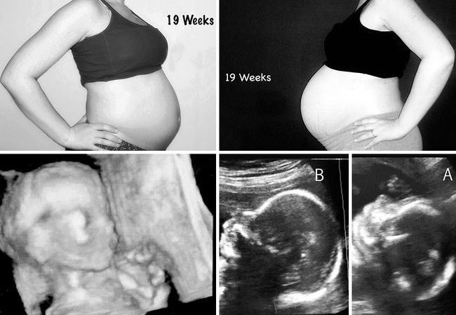 Nếu bạn tò mò mang thai đơn và song thai khác nhau thế nào, hãy xem những hình ảnh này - Ảnh 4.