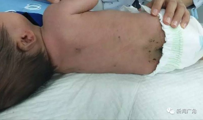 Bé sơ sinh 40 ngày tuổi bị đâm 30 mũi kim vì bà ngoại tin bài thuốc dân gian chích máu - Ảnh 1.