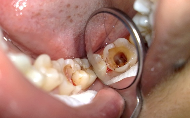 Dù chỉ đau răng thoáng qua, đừng coi thường: Đây có thể là lời cảnh báo bệnh nguy hiểm - Ảnh 1.