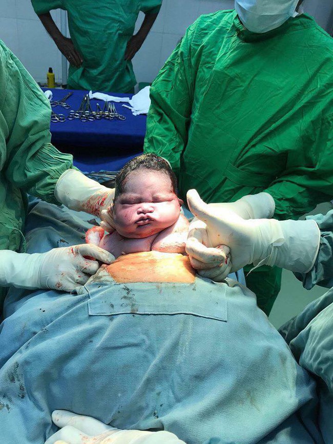 Bức ảnh gây bão mạng: Em bé sơ sinh đang ngủ ngon thì bị bác sĩ đưa ra khỏi bụng mẹ trong ca sinh mổ - Ảnh 1.