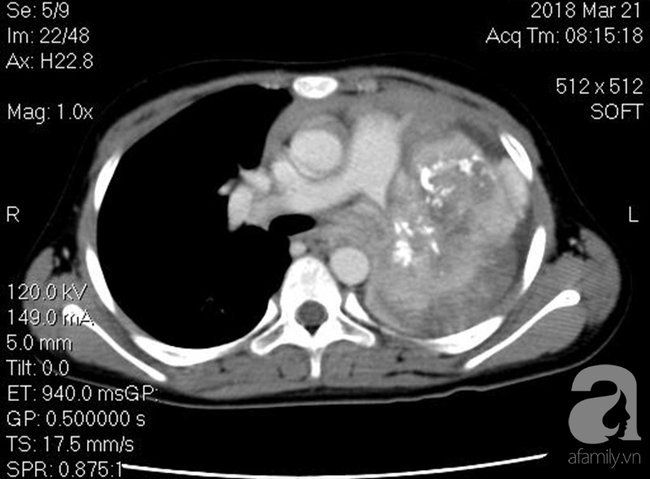 Bé gái Đồng Nai khó thở, suýt mất mạng trên bàn mổ vì mang khối u phổi chỉ 16 người trên thế giới gặp phải - Ảnh 1.
