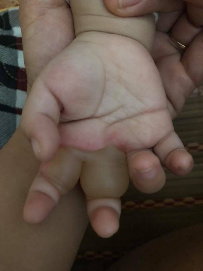 Bò chơi quanh nồi cơm điện, bé 1 tuổi bị bỏng hơi để lại sẹo co rút các ngón tay - Ảnh 3.