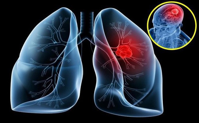4 người cùng phòng làm việc bị ung thư phổi, báo động về nguy cơ bị ung thư ngay cả khi bạn không hút thuốc - Ảnh 1.