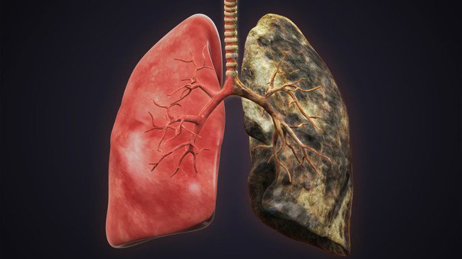 4 người cùng phòng làm việc bị ung thư phổi, báo động về nguy cơ bị ung thư ngay cả khi bạn không hút thuốc - Ảnh 4.