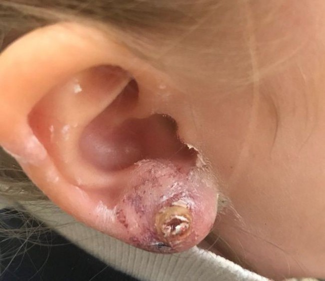 Nguy hiểm từ việc bấm lỗ tai làm đẹp cho bé ít cha mẹ nào nghĩ tới - Ảnh 3.