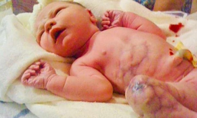 Vừa chào đời, em bé đã khiến mẹ nghĩ có gì sai sai vì những vết bầm tím trên chân con - Ảnh 1.