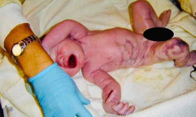 Vừa chào đời, em bé đã khiến mẹ nghĩ có gì sai sai vì những vết bầm tím trên chân con - Ảnh 2.