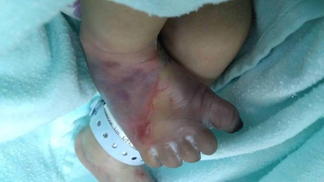 Chào đời hoàn toàn khỏe mạnh, nhưng sau khi lấy máu xét nghiệm, bàn chân bé sơ sinh bỗng thâm đen đến đáng sợ - Ảnh 3.