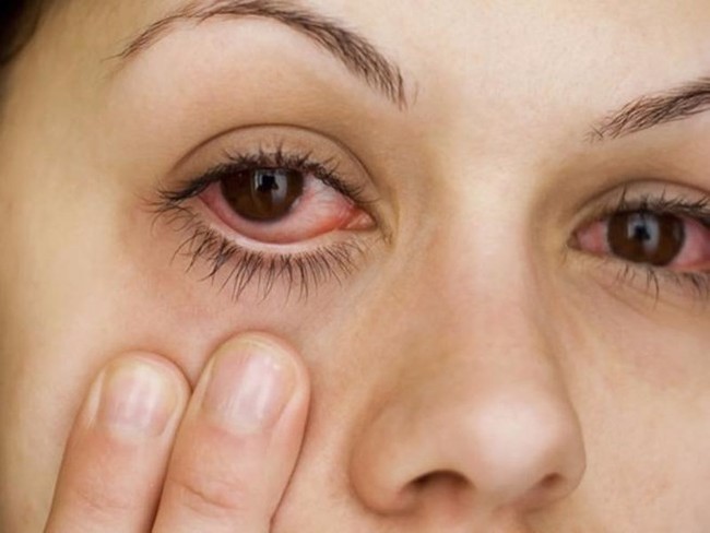 Người phụ nữ tự ý chữa đau mắt khiến suýt mù: Chuyên gia cảnh báo đừng dại làm theo cách chữa đau mắt phản khoa học này - Ảnh 2.