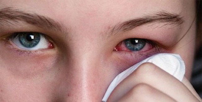 Người phụ nữ tự ý chữa đau mắt khiến suýt mù: Chuyên gia cảnh báo đừng dại làm theo cách chữa đau mắt phản khoa học này - Ảnh 4.