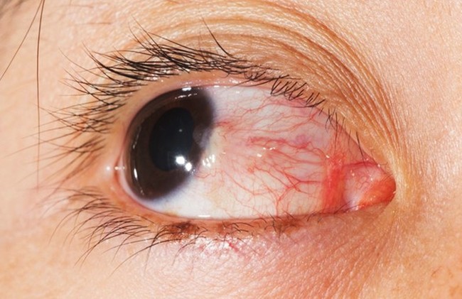 Mắt xuất hiện màng máu: Không ít người Việt mắc căn bệnh này dẫn đến nguy cơ biến dạng tròng đen và giảm thị lực - Ảnh 1.