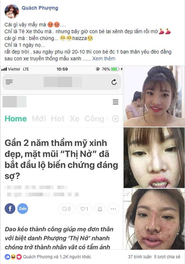 Sự thật về tin đồn hot girl thẩm mỹ Phượng Thị Nở bị biến chứng sau thẩm mỹ khiến mặt mũi biến dạng? - Ảnh 3. Sự thật về tin đồn hot girl thẩm mỹ Phượng Thị Nở bị biến chứng sau thẩm mỹ khiến mặt mũi biến dạng? - Ảnh 3.