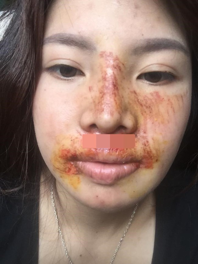 Sự thật về tin đồn hot girl thẩm mỹ Phượng Thị Nở bị biến chứng sau thẩm mỹ khiến mặt mũi biến dạng? - Ảnh 1. Sự thật về tin đồn hot girl thẩm mỹ Phượng Thị Nở bị biến chứng sau thẩm mỹ khiến mặt mũi biến dạng? - Ảnh 1.