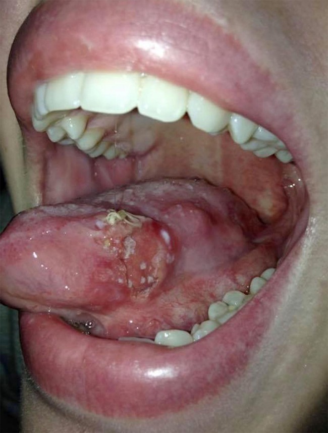 Có vết loét trong miệng nhưng bác sĩ cũng không ngờ là dấu hiệu ung thư lưỡi - câu chuyện của cô gái đáng thương - Ảnh 2.