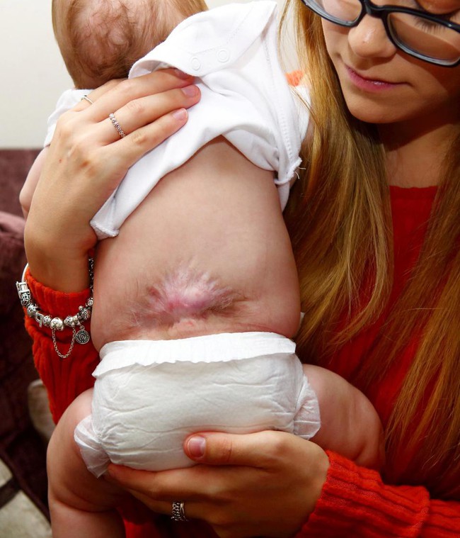 Thai nhi 20 tuần tuổi bác sĩ chỉ định phẫu thuật cột sống ngay trong tử cung, con chào đời bố mẹ mới nhìn thấy vết sẹo trên lưng con - Ảnh 5.