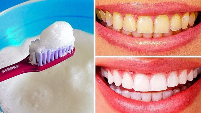 Bạn muốn tẩy trắng răng? Trước hết hãy đọc 5 lời khuyên này của nha sĩ - Ảnh 2.