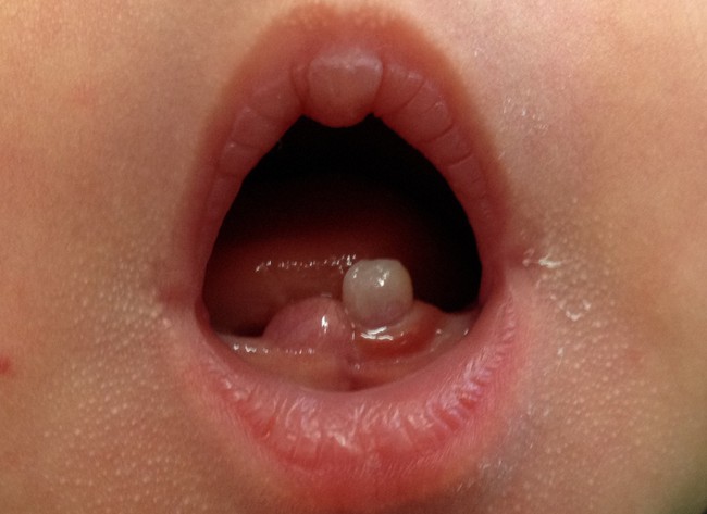 Bé vừa chào đời bố mẹ đã thấy có răng trong miệng: Bình thường hay đáng lo ngại? - Ảnh 2.