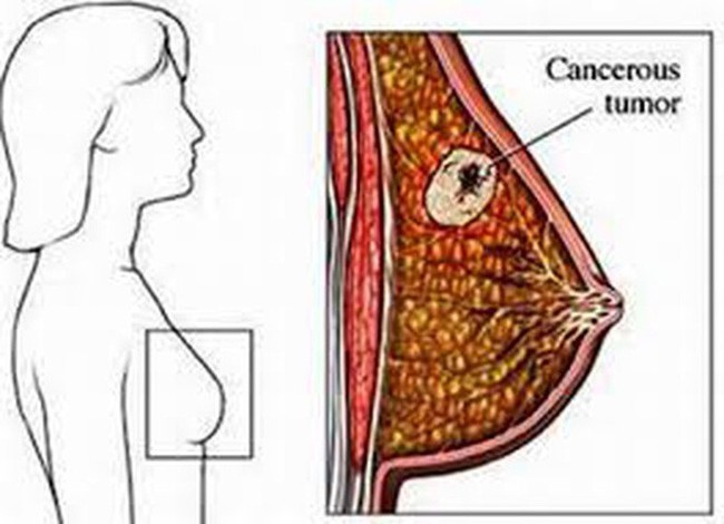 3 dấu hiệu ung thư vú đang tiến triển trong người: Học ngay cách tự khám để phát hiện sớm - Ảnh 2.